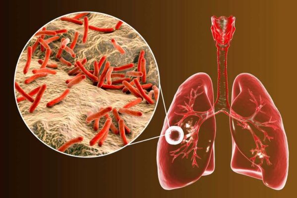 tuberkulosis